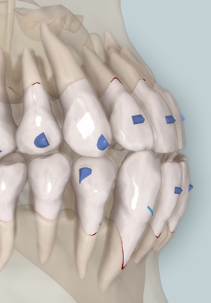 invisalign