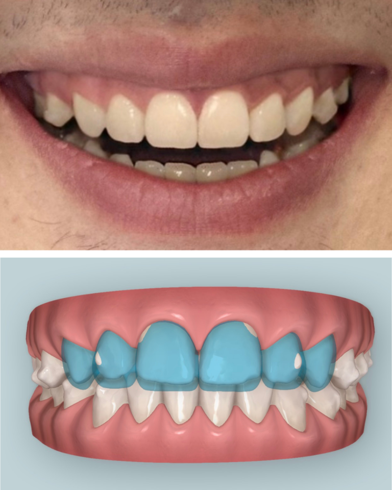 invisalign